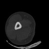 SPORK, NICO - 22.03.1976 - 02.08.2022 - CT obere Extremität - 17:51:17